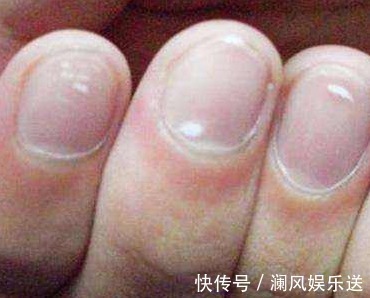 肚子疼|孩子有这“4个”表现,说明肚子里“长虫”了!爸妈们一定要注意