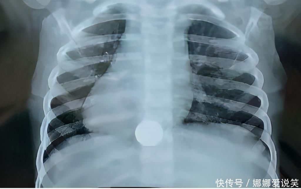 小宝|孩子误吞硬币、意外受伤该怎么办?儿科医生提醒:这样做才正确