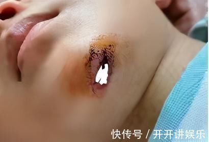美容|孩子误吞硬币、意外受伤该怎么办?儿科医生提醒:这样做才正确