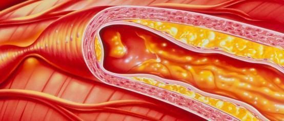 毒素|“溶栓高手”被发现,不是木耳洋葱,平时可多喝,血管逐步变干净