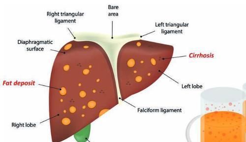  喝酒|如果四个症状全都有，肝可能已经“硬梆梆”，爱喝酒的人赶快自查