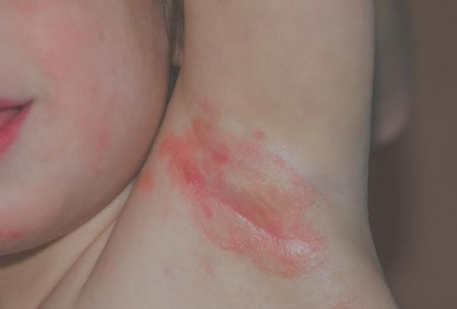 湿疹|宝宝湿疹的3个治疗误区，别再走“弯路”了！