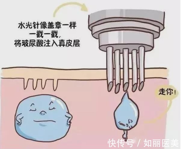 水光 「医美科普」水光针停打,皮肤会变比之前更差吗?