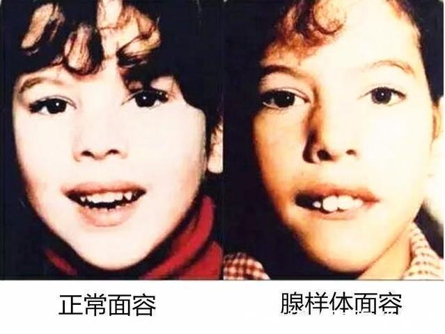 牙弓|孩子睡前的一个坏习惯,正悄悄毁掉自身颜值,很多父母还没察觉到