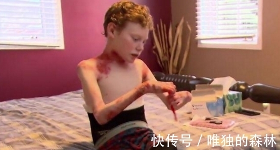 皮肤|男孩皮肤一碰就流血,每天裹满纱布,泡在浴缸里减轻痛苦