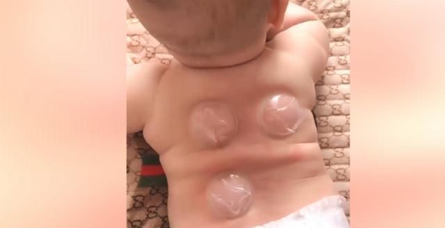 妈妈|妈妈用吃果冻的杯子,给萌娃拔火罐，网友宝宝很享受的样子