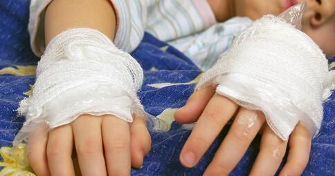 用水冲|男婴被100度开水烫伤后,妈妈做法遭全家反对,却得到医生点赞