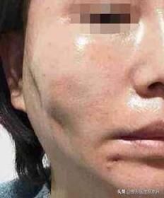线雕6个月后脸仍旧凹凸不平,问题出在哪?还能救吗?