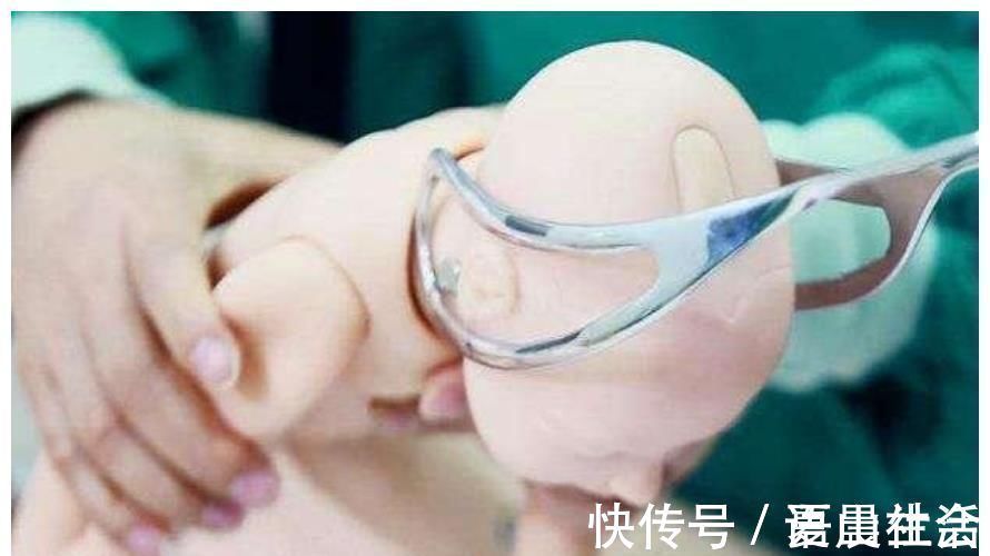 印记|宝宝脸上“产钳印”未消除，婆婆开启“责怪模式”，宝妈好心塞！