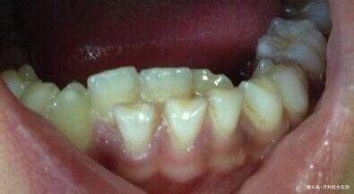 牙齿|孩子乳牙滞留，形成“双排牙”应该怎么办