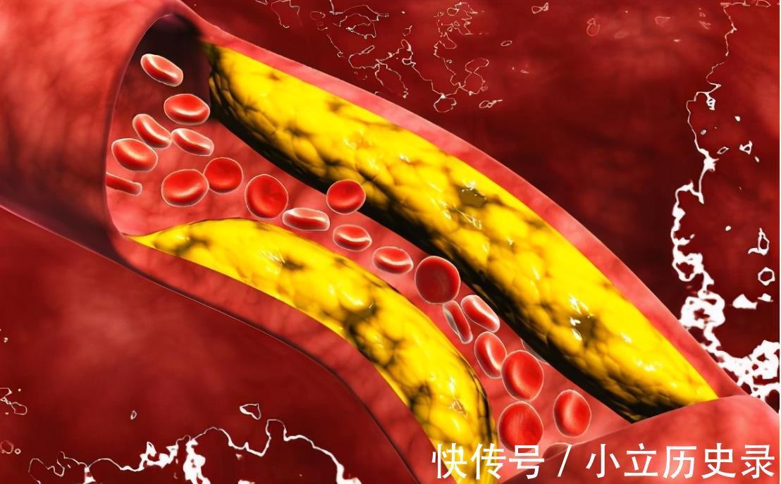 血管堵塞|研究脑梗40年，83岁院士，“3白”容易升血脂，劝你早日忌口