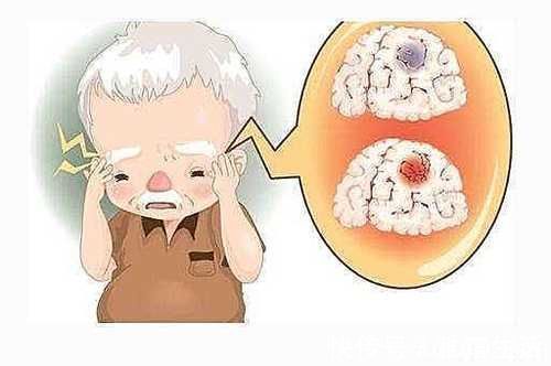 症状|脑梗来访,头部先知!头部若出现这几“症状”,或是脑梗离不不远