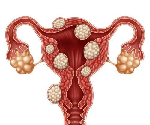 子宫肌瘤|它是子宫肌瘤的“死对头”，喝水时加点，活血暖宫，子宫更健康