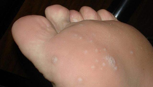 甲亢|大病来临前，身体会出现3个征兆！经常对照，及时预防