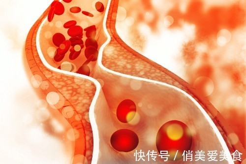 血脂|养血管等于攒寿命!血脂越高,3种病越容易找上门,希望你不占