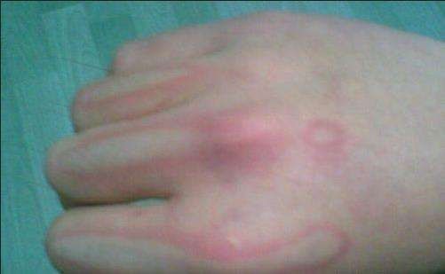 皮肤|突发情况意外烫伤怎么处理这几个应急方法都很管用