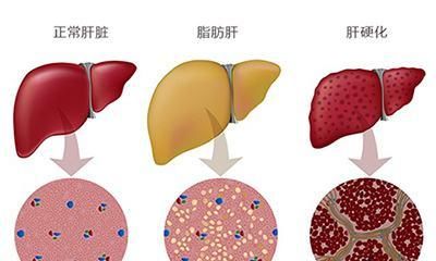 糖尿病|老中医教你“对症下药”,打通淤堵,疏肝化痰,消灭脂肪肝
