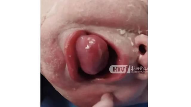 章樱|罕见！杭州一女宝宝出生时口含“龙珠”！竟是……