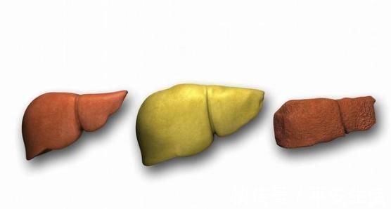 高蛋白|检查出脂肪肝,该怎么治?记准这2点,慢慢消掉脂肪肝!速看