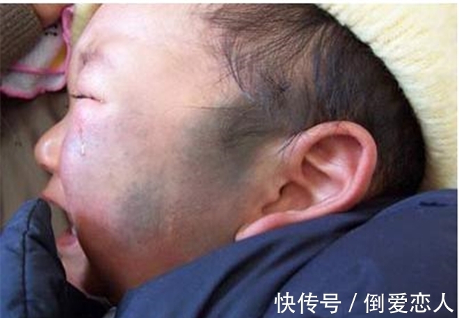 胎记|孩子出生身上有胎记,是孕期做这些事造成的,很多宝妈没在意