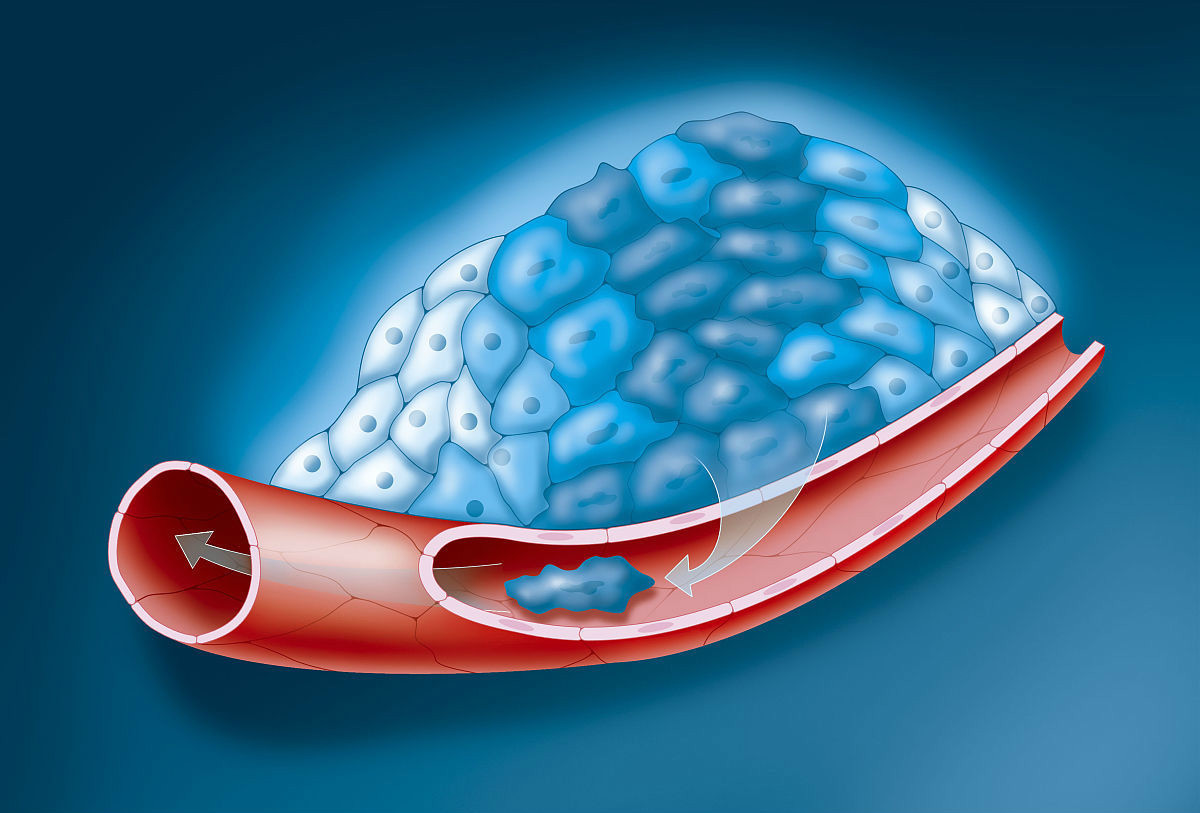 血管狭窄|血管一天比一天狭窄,三种食物最好多吃一点,能离血栓更远