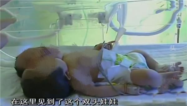 心理健康|孕妇生下罕见“双头婴”,众人都来围观,专家的话却令人担忧