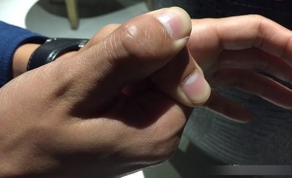 糖尿病患者|糖尿病者,一旦手脚有四种变化,并发症来了,再拖下去就是肾衰竭