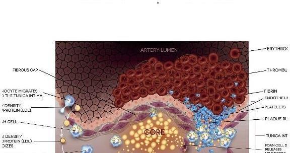 脑中风|血脂高对身体危害大，许多人体检才知道，你知道血脂高的征兆吗？
