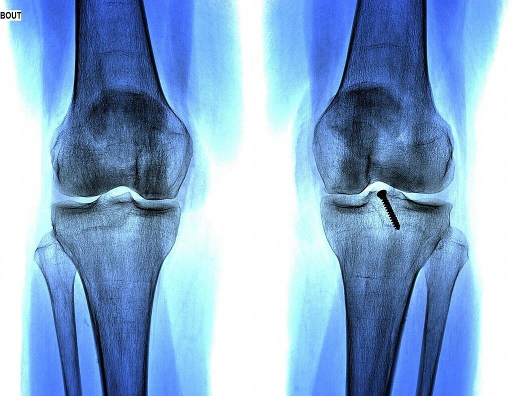 骨骼线|9岁男孩骨骼线完全闭合,检查结果出来后,家长引咎自责