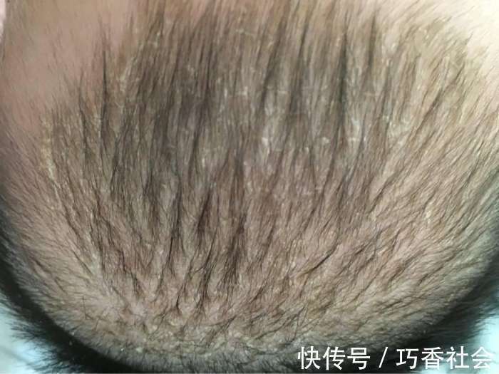 怒斥|刚满月的宝宝就高烧不退!医生看到宝宝的头皮后怒斥她不配做妈妈