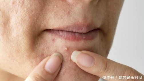 饮食|肝火旺的人,多数有5种表现,你有吗?