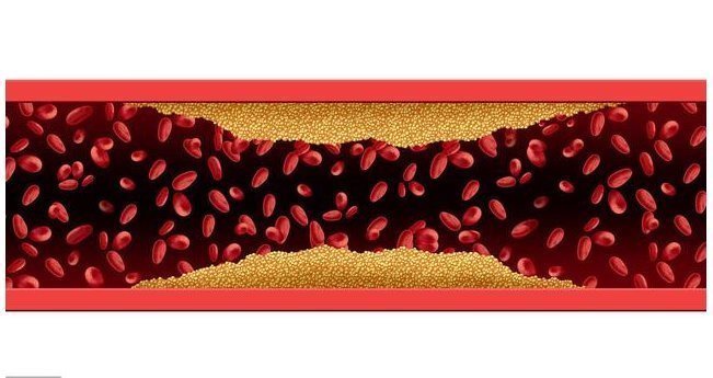 他汀药|脑梗不到1年就复发,如何预防?坚持做好3件事,养血管保健康