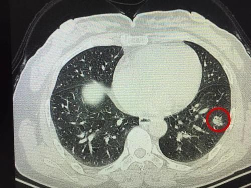 肿块|结节是肿瘤吗?癌变的几率有多大?医生带您了解身上的凸起、肿块