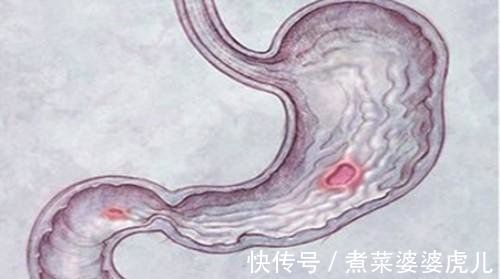 紫菜|胆汁反流性胃炎，看似小毛病，或许暗示4种胃病，一拖就很麻烦！