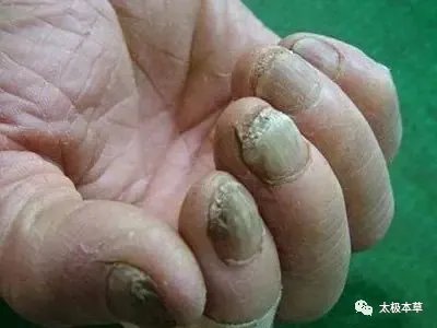 调匀|手脚出现的小毛病,用简易良方,原料易得,收藏吧·