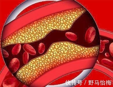 低压|单纯低压高是不是高血压要不要降压长期低压高有什么危险