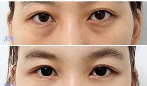 别随便做“眶隔脂肪释放”祛眼袋手术，否则会“后悔”？