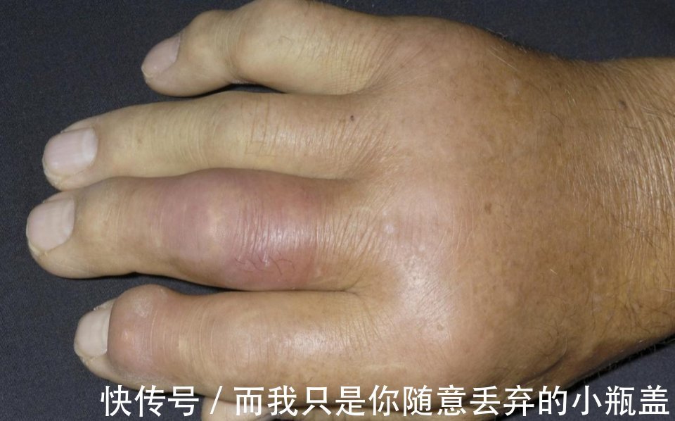 源头|降尿酸，要控制好源头，嘌呤只是表象，做好2点有助远离痛风