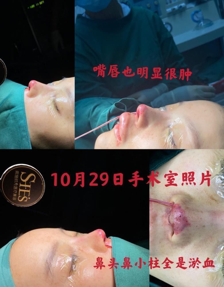 星途|又一女星整容失败,不仅星途尽毁,还面临赔付高额违约金