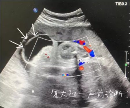 尾巴|崩溃！女子怀孕5个月，发现胎儿竟有“尾巴”