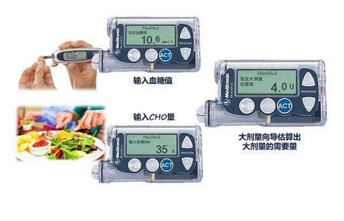 糖友|美敦力胰岛素泵告诉你为什么戴泵比打针好？