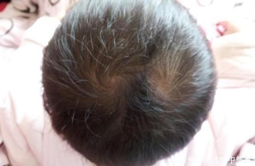 实验|为什么有的孩子头上有2个“旋”有关发旋的误解,你知道多少!