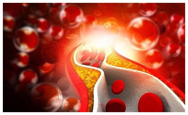 晴雨表|双腿或是血脂的“晴雨表”腿上出现这3种现象，血脂可能偏高了