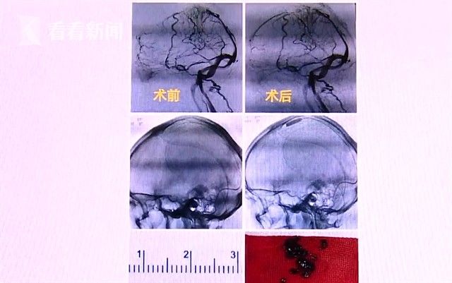 小明|1天10杯！男子奶茶当水喝住进ICU，颅内长出…