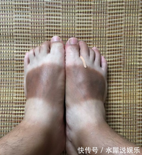 大赛|男子晒“渐变色”皮肤，网友不服，一场“比惨”大赛开始了