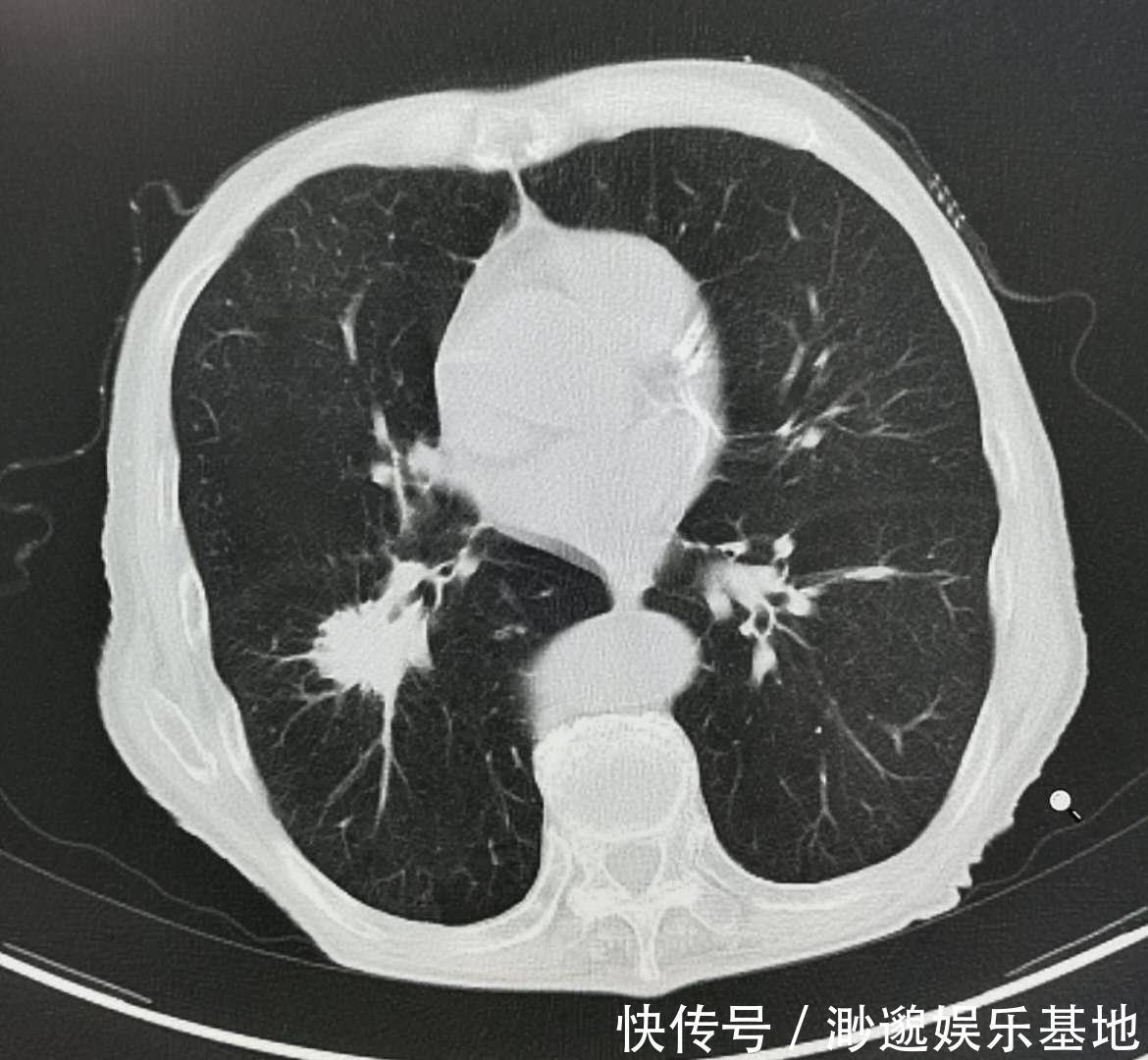 明明知道癌症治不好,为什么医院还有治呢?