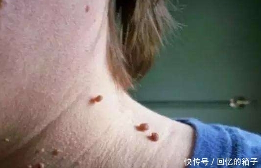 脖子|为什么有的人脖子上长“小肉瘊”,可能与3点有关