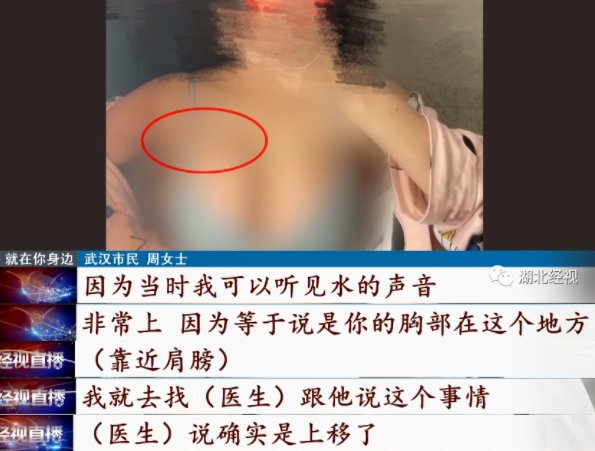 肩膀|女子隆胸后假体移位:“胸长到肩膀下面了”