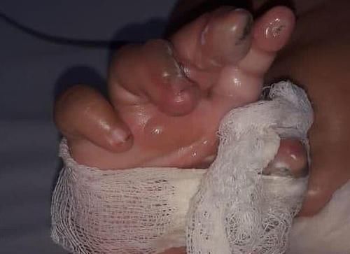 重症监护室|6个月宝宝将“电线”咬漏电，被电晕后又烧伤，父母发现后哭惨了