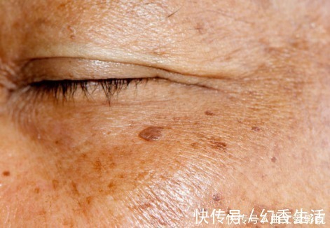 医生|为什么年纪轻轻有老年斑？医生直言：常吃2物，远离老年斑！